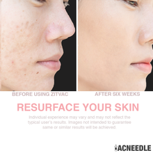 Load image into Gallery viewer, ZITVAC - Microdermabrasion Pore Cleanser
